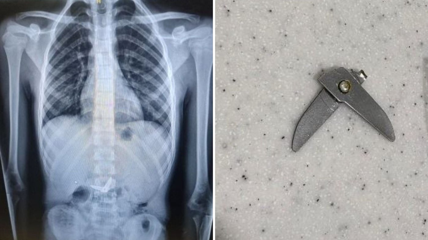 צילום רנטגן של המספריים, ואחרי שהם יצאו בשלום