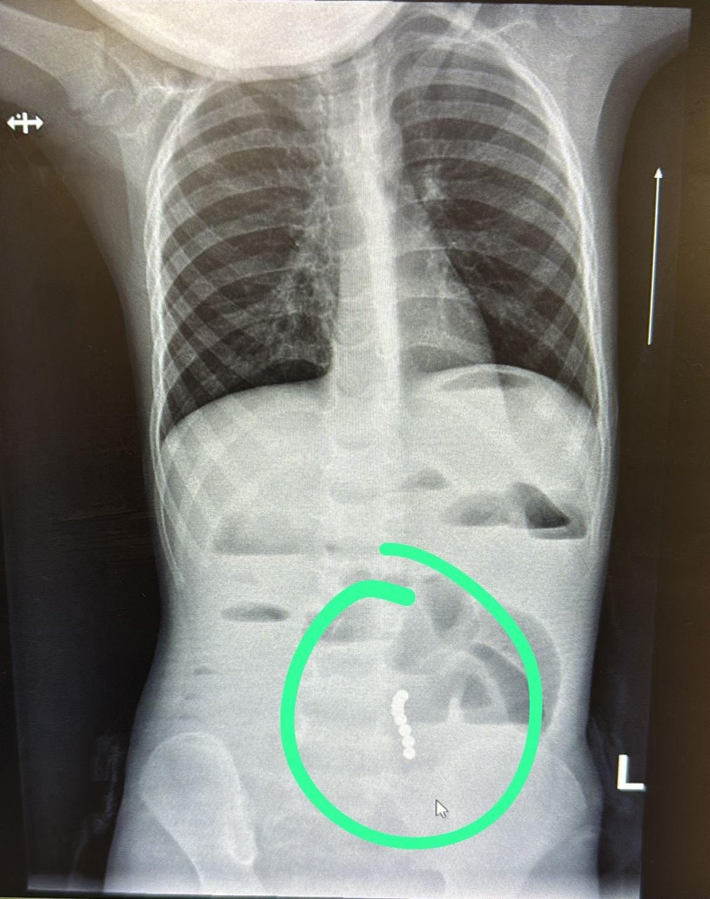 המגנטים שבלע הילד