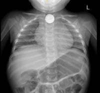 צילום הרנטגן שבו התגלתה הסוללה בוושט