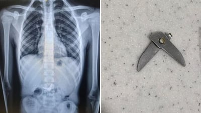 צילום רנטגן של המספריים, ואחרי שהם יצאו בשלום