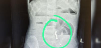 לא ייאמן: ילד בן 4 סבל מכאבי בטן והקאות - זה מה שנמצא בבדיקות המקיפות