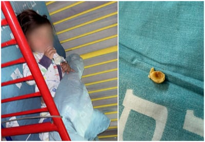 האגוז שהוצא מן הושט והפעוט במהלך הטיפול של הצוות הרפואי